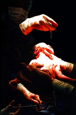 Caesarean Birth